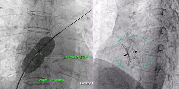 Kích thước lỗ thông 22cm qua kết quả thông tim dưới màn tăng sáng và hình sau can thiệp bít lỗ thông bằng dụng cụ dù.