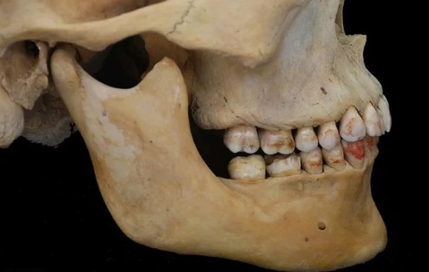 Dấu vết chu sa vẫn rõ ràng trên răng người phụ nữ trẻ sau hơn 2.000 năm - Ảnh: Archaeological and Anthropological Sciences