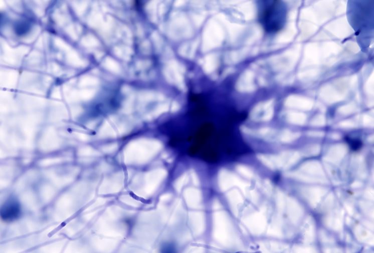 Các tế bào não được gọi là tế bào hình sao có thể là một trong những chìa khóa dẫn đến bệnh Alzheimer. Ảnh: Getty