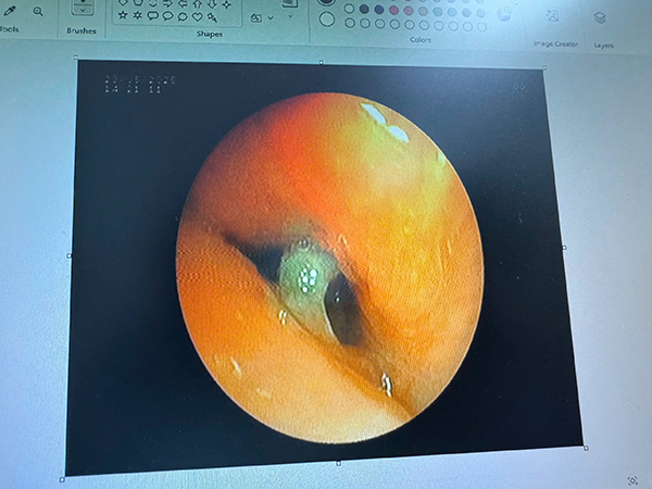 Hình ảnh nội soi phát hiện dị vật trong phế quản của cụ bà L.T.T.R.