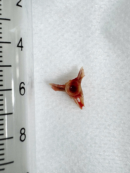 mảnh xương  cá mắc trong đường thở của bệnh nhân Nguyễn Văn T