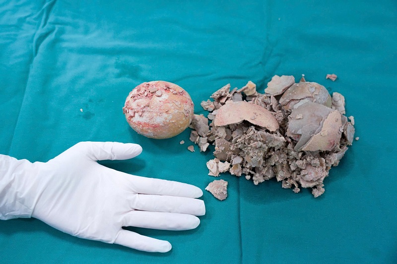 Viên sỏi khổng lồ lấy ra từ bàng quang của nữ bệnh nhân.