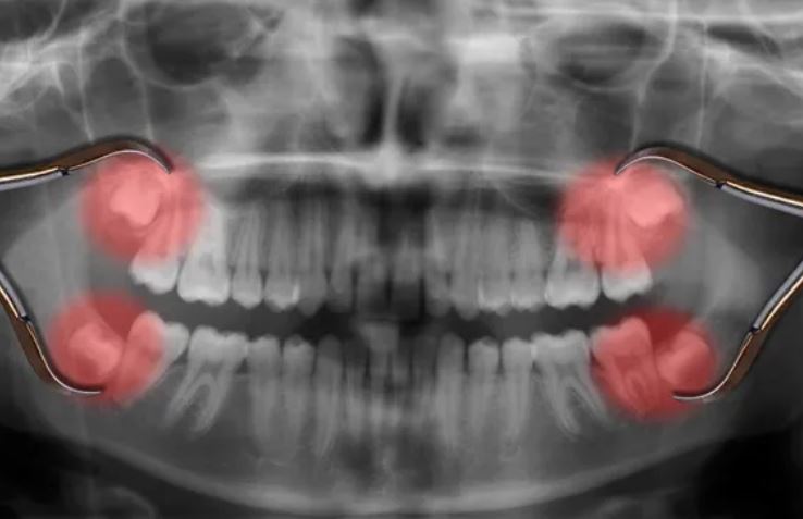 ăng khôn được đánh dấu trên phim chụp X-quang. (Nguồn ảnh: Getty Images)