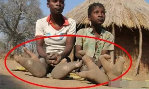 Bộ tộc 'đà điểu' gốc Phi chỉ có 2 ngón chân, các chuyên gia đã đến để tiết lộ sự thật