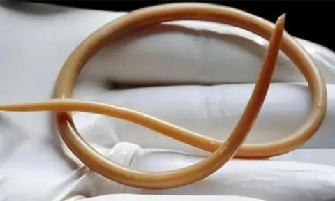 Cách đây vài chục năm, hầu hết mọi người đều có giun đũa trong bụng, tại sao bây giờ người ta ít nghe nói đến?