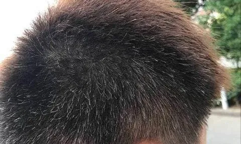 Tóc bạc mọc ở đâu, bệnh tật sẽ đến từ đó? Nếu mọc ở trán, thái dương, sau đầu thì có nghĩa là gì?