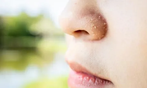 Hiện tượng 'gàu quanh mũi' là gì? Có nguy hiểm không? Và điều chúng ta ít biết về cơ thể mình!