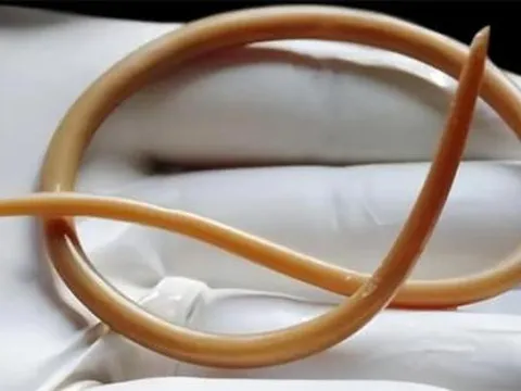 Cách đây vài chục năm, hầu hết mọi người đều có giun đũa trong bụng, tại sao bây giờ người ta ít nghe nói đến?
