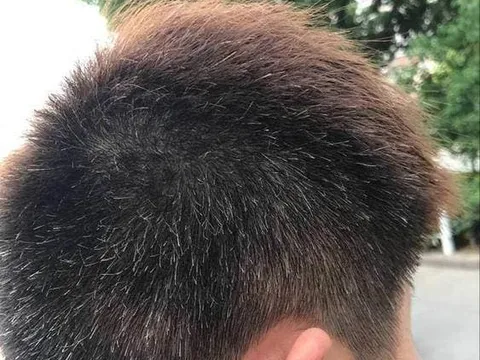 Tóc bạc mọc ở đâu, bệnh tật sẽ đến từ đó? Nếu mọc ở trán, thái dương, sau đầu thì có nghĩa là gì?