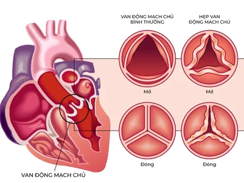 Bệnh viện FV ứng dụng công nghệ thay van động mạch chủ thế hệ mới nhất
