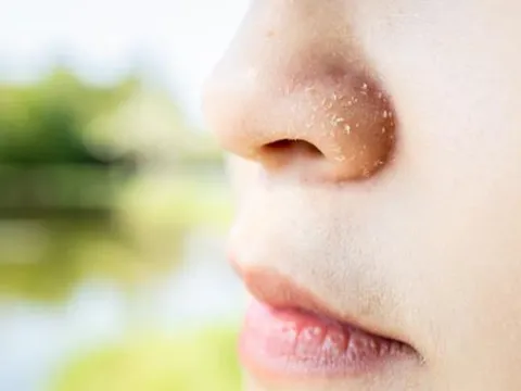 Hiện tượng 'gàu quanh mũi' là gì? Có nguy hiểm không? Và điều chúng ta ít biết về cơ thể mình!