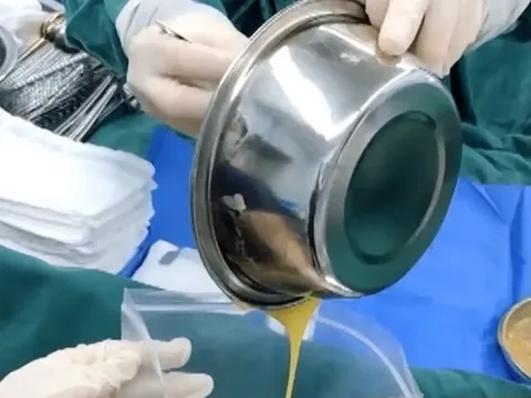 Bị lừa nâng ngực bằng collagen động vật, cô gái tốn 8,4 tỷ đồng nhưng ngực vẫn biến dạng 