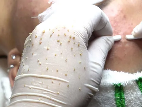 Vì sao hàng triệu người "nghiện" xem clip nặn mụn?