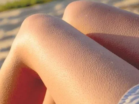 Vì sao con người lại nổi da gà? Phản xạ cổ xưa của tổ tiên vẫn còn hiện diện