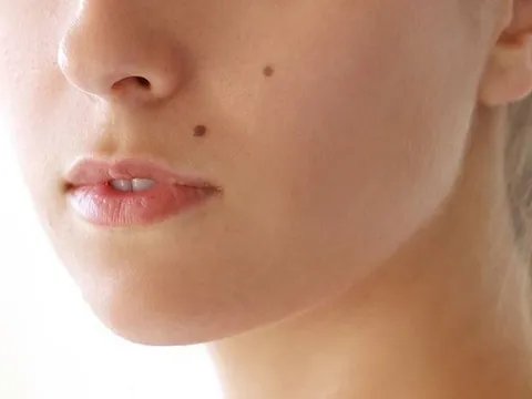 Vì sao con người lại có nốt ruồi? Bí ẩn nhỏ bé trên làn da tiết lộ điều gì về cơ thể bạn