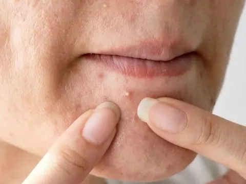 Vì sao những clip nặn mụn đáng sợ lại thu hút hàng triệu lượt xem? Chuyên gia lý giải hiện tượng gây tranh cãi