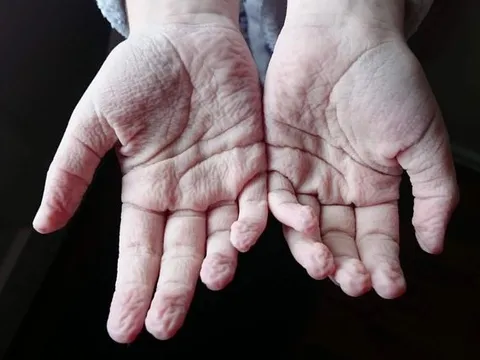 Lý giải bất ngờ về hiện tượng ngón tay nhăn nheo khi ngâm nước lâu