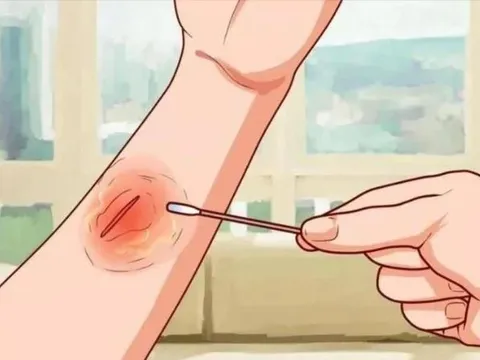 Con người chữa lành vết thương chậm hơn gấp ba lần so với họ hàng linh trưởng gần nhất