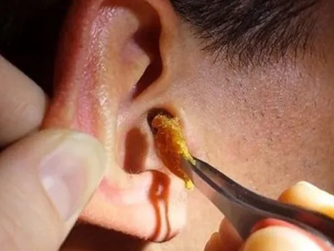 Tại sao chúng ta có ráy tai?