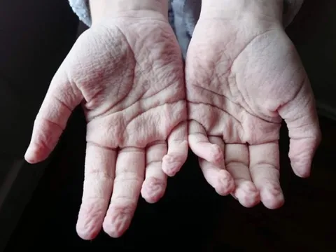 Bí mật sinh học đằng sau hiện tượng ngón tay nhăn nheo khi ngâm nước lâu