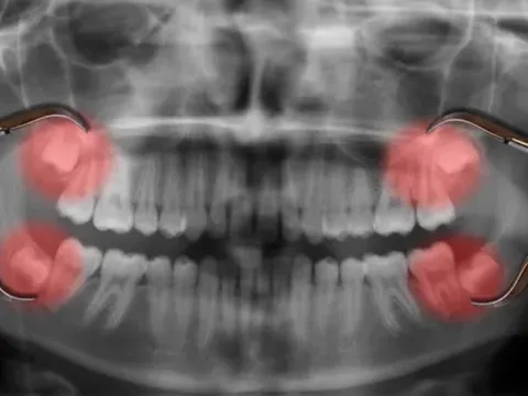 Tại sao răng khôn lại mọc muộn?