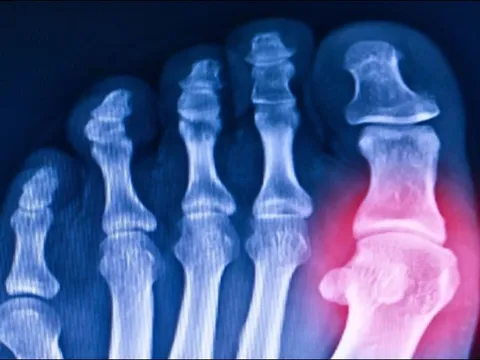 Các nhà khoa học ‘hồi sinh’ gen 20 triệu năm tuổi giúp chống lại bệnh gout