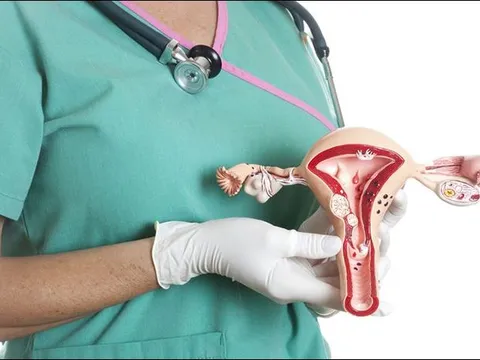 Cắt bỏ tử cung có thể làm tăng nguy cơ đột quỵ