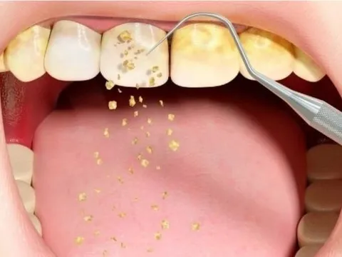 Chuyện gì sẽ xảy ra nếu không lấy cao răng?